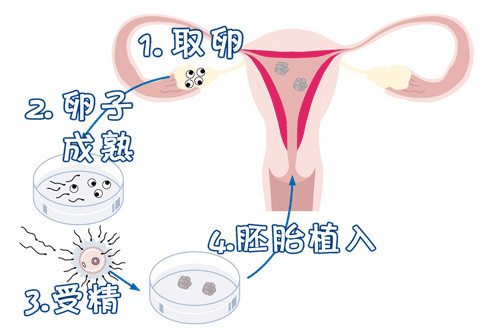 染色体易位案例